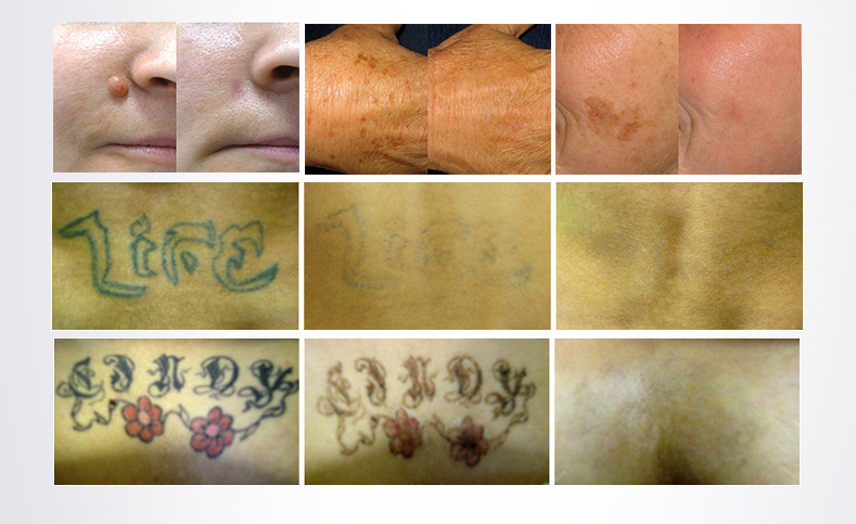 Aprobación CE Equipo de belleza láser Eliminación de tatuajes q cambió nd yag lase precio